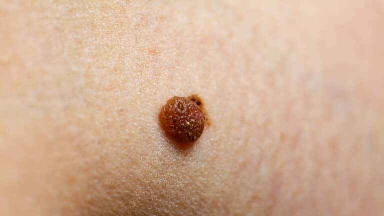 11 Signs It’s Time to Get Your Moles Checked Out by Your Dermatologist